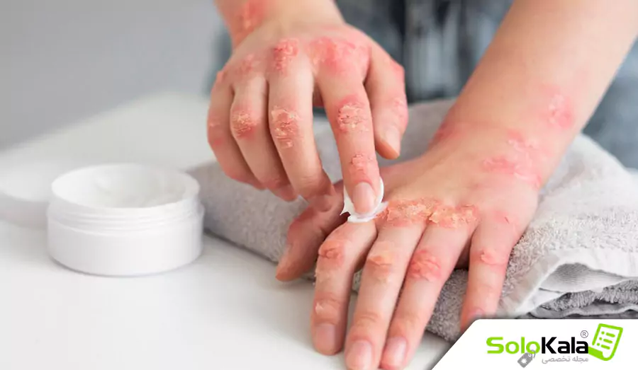 تفاوت بین اگزما و درماتیت